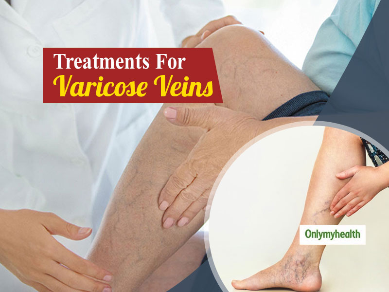 Treat Varicose Veins On Time To Avoid Serious Complications