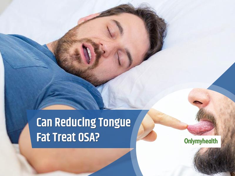 To Treat Sleep Apnoea, First Reduce Fat From Your Tongue: Study