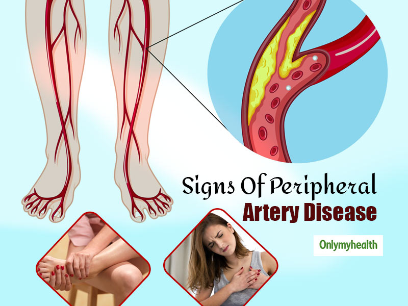 Peripheral Artery Disease: Acute Pain In Chest And Leg Are  
