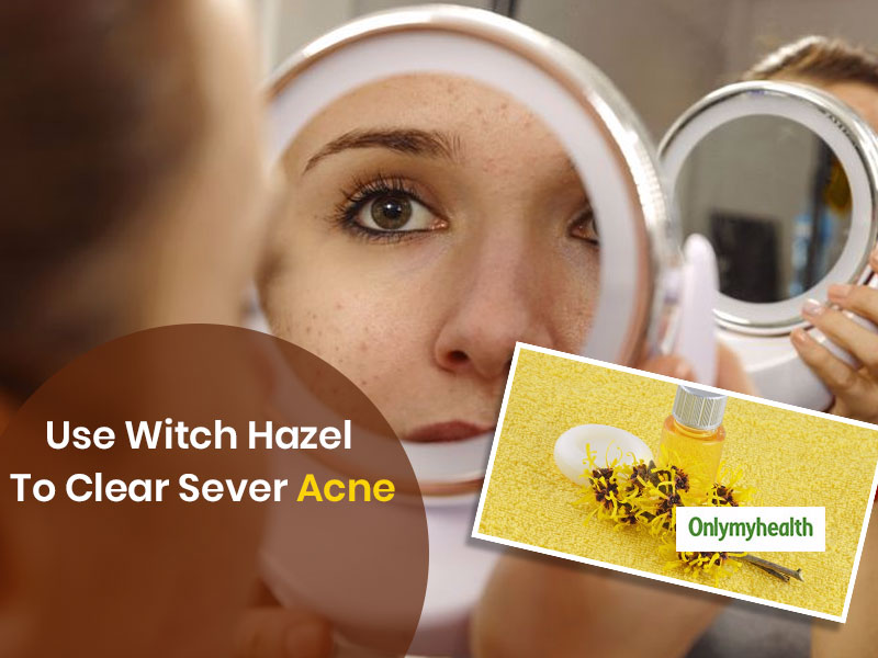 Home Remedies For Acne: Use Witch Hazel For Pimple-Free and Clear Face