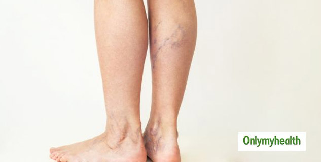 Treatment of Varicose