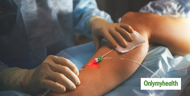 Varicose Treatments  