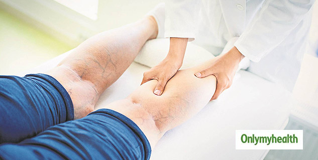 Varicose Veins surgery 