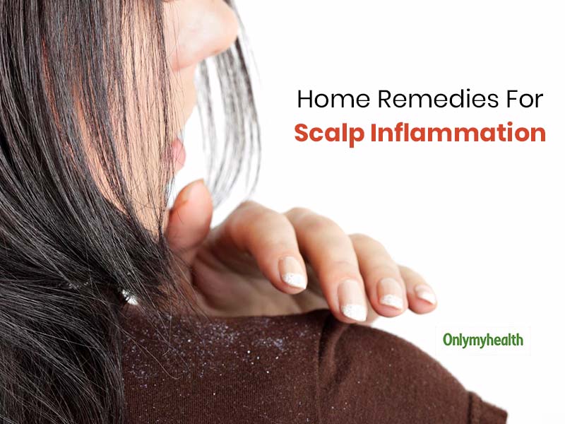 Scalp Inflammation Home Remedies: These 5 Signs Of Scalp Inflammation Can Be Treated At Home