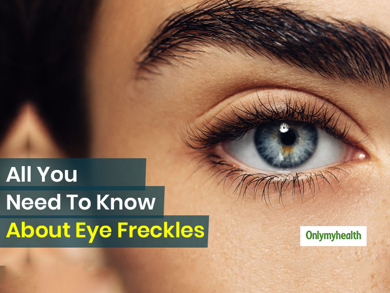 Eye Freckles Can Be An Initial Symptom Of Eye-Related Disorders