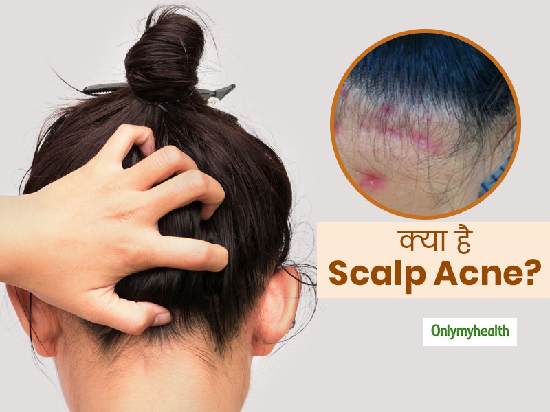 कई कारणों से होता है बालों के स्कैल्प पर पिंपल्स, जानें 'स्कैल्प एक्ने' के कारण और बचाव के उपाय