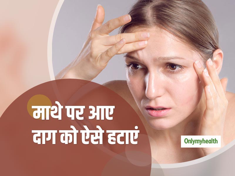 माथे पर होने वाले दाग से हैं परेशान? जानें इसको हटाने के ये 5 आसान तरीके 