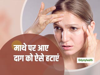माथे पर होने वाले दाग से हैं परेशान? जानें इसको हटाने के ये 5 आसान तरीके 