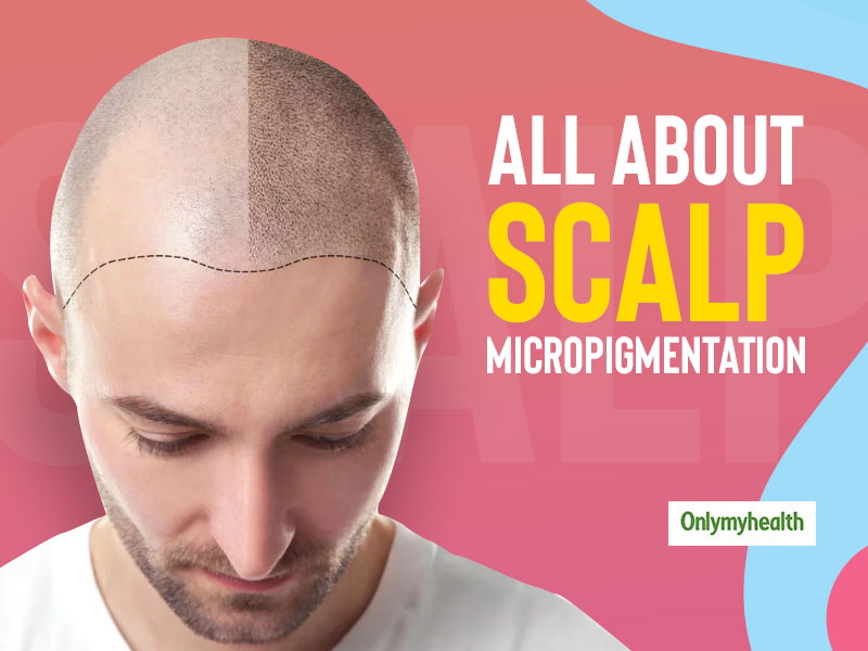 Hair Tattoo or Scalp Micropigmentation: The New Hair Trend