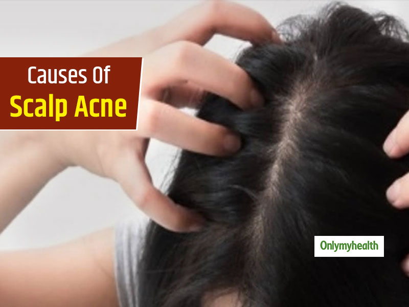 Do You Have Acne On Scalp? Know The 5 Main Causes Of Scalp Acne ...