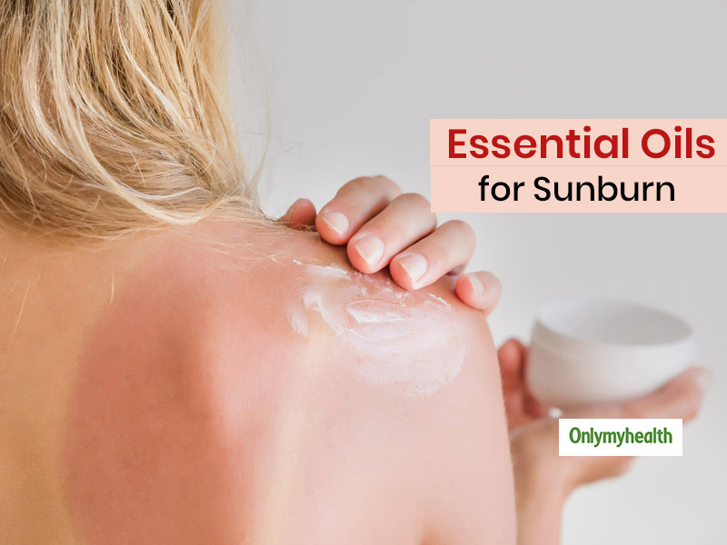Got Sunburns? Here Are 4 Essential Oils That You Can Apply For Rapid Relief