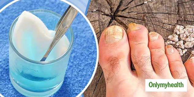 Hydrogen Peroxide Athlete's Foot Treatment