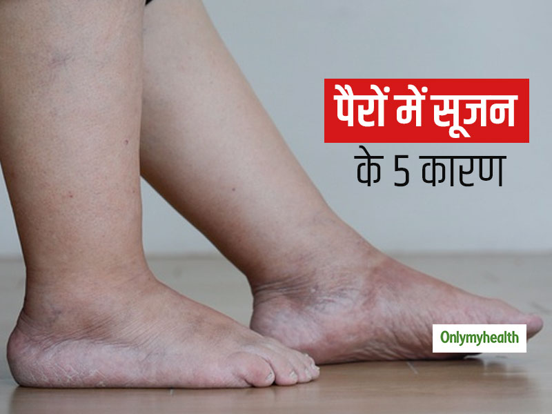 अगर आपके पैरों में सूजन रहती है तो इन 5 बीमारियों में से हो सकती है कोई एक वजह, तुरंत कराएं जांच