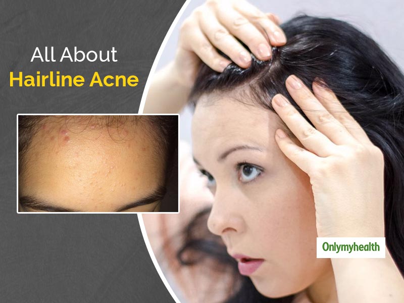 Hairline Acne: What Is This and How This Can Be Treated
