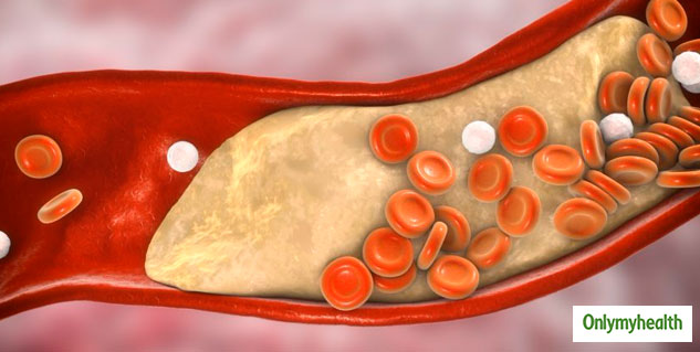 bad cholesterol in blood 