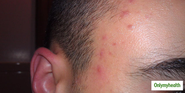 Hairline Acne What Is This And How This Can Be Treated Onlymyhealth