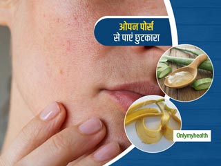 Home Remedies For Open Pores: चेहरे के ओपन पोर्स से छुटकारा पाना है, तो आज ही अपनाएं ये 3 घरेलू उपाय  