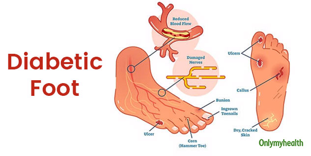 insidediabeticfoot