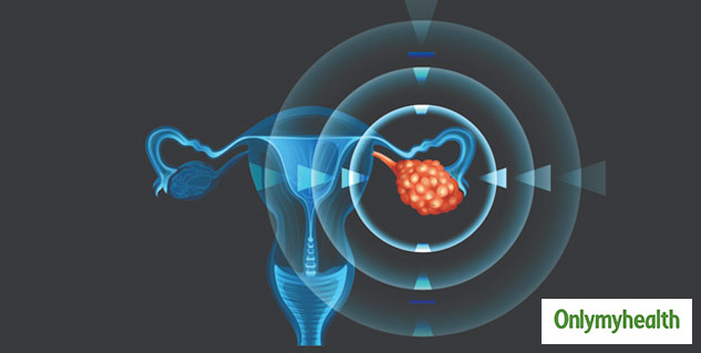 Ovarian Cancer Risk