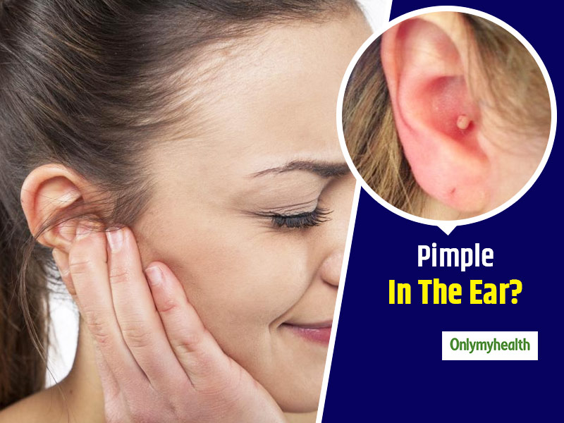 Pimple In Ear How To Prevent And Treat Ear Acne Ph