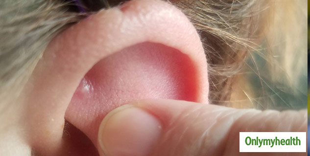 Pimple in Your Ear: Why You Get Acne in Your Ear and How to Treat