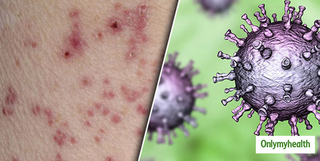 4 Types of Viral Skin Infections And Their Characteristics For Timely 