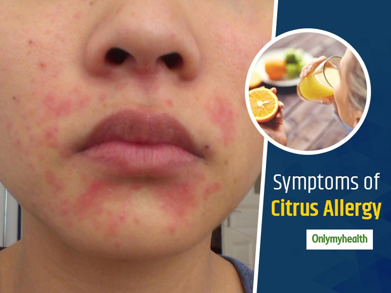 Food Allergy Symptoms On Face