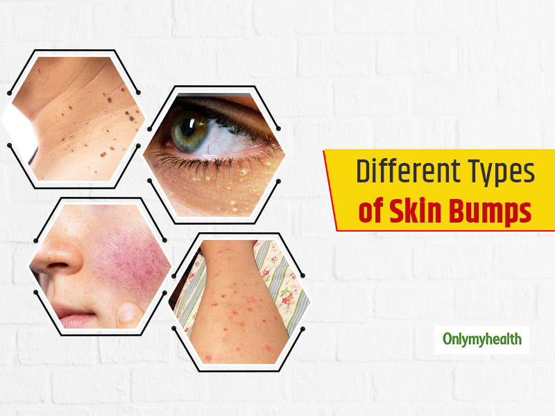 Guide To Different Types of Skin Bumps And Tips To Treat Them Naturally
