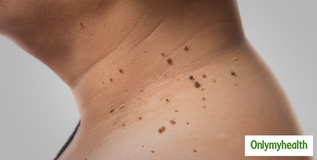 Guide To Different Types of Skin Bumps And Tips To Treat