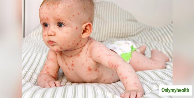 Tips To Identify and Diagnose A Viral Rash in Infants | OnlyMyHealth