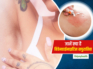 त्वचा पर दिखने वाले इस तरह के लक्षण हो सकते हैं Hidradenitis suppurativa का संकेत, जानें क्या है वजह