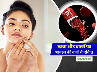 Iron Deficiency:  बालों और त्‍वचा में दिखें ये बदलाव, तो समझ जाएं शरीर में है आयरन की कमी 