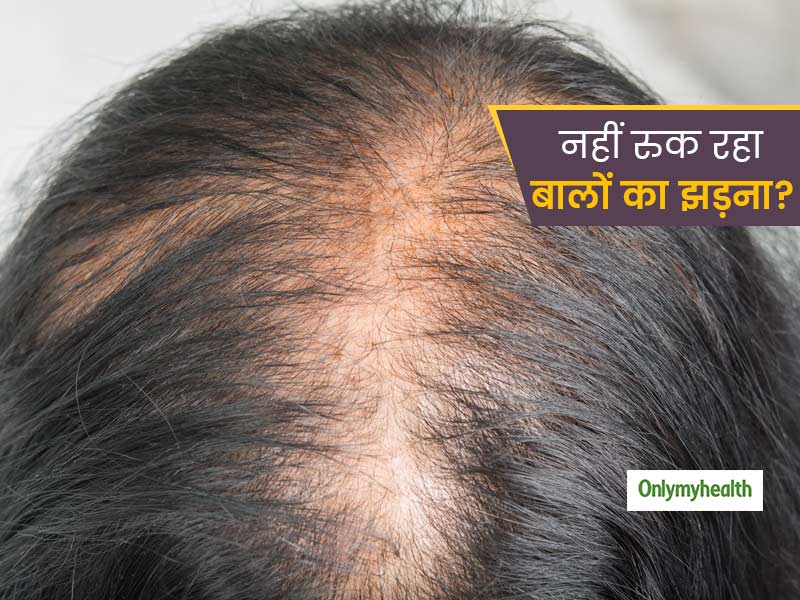 Hair Care 5 Common Causes of Constant Hair Loss in Men and Women After Age  25 in Hindi | तमाम प्रयासों के बाद भी नहीं रुक रहा है बालों का झड़ना, तो