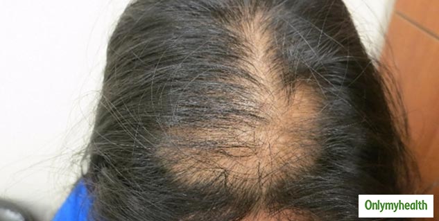 hair loss causes scalp