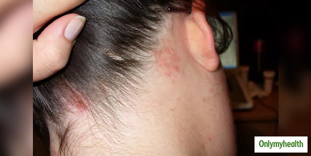 insidescalpinfection