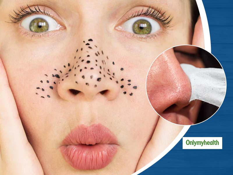 Blackheads On Face? Here Are The Causes, Symptoms And Treatment