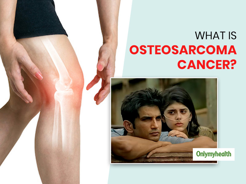 What Is Osteosarcoma Cancer That Sushant Singh Rajput Is Suffering From in His Last Movie Dil Bechara
