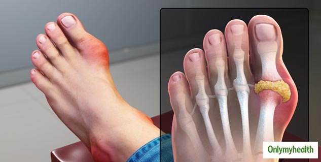 gout remedies