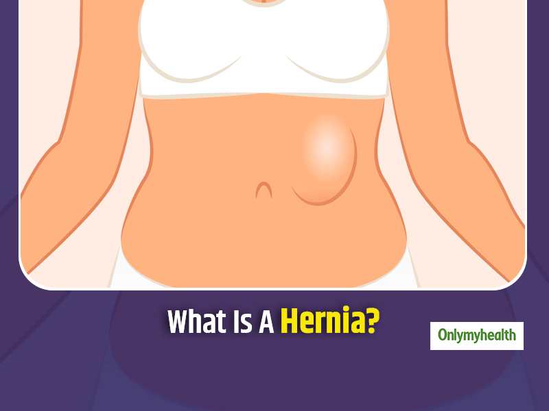 What Does A Sliding Hernia Mean