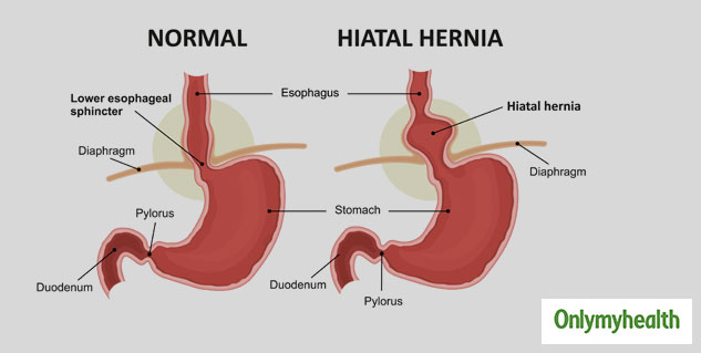 Types of Hernia in Adults