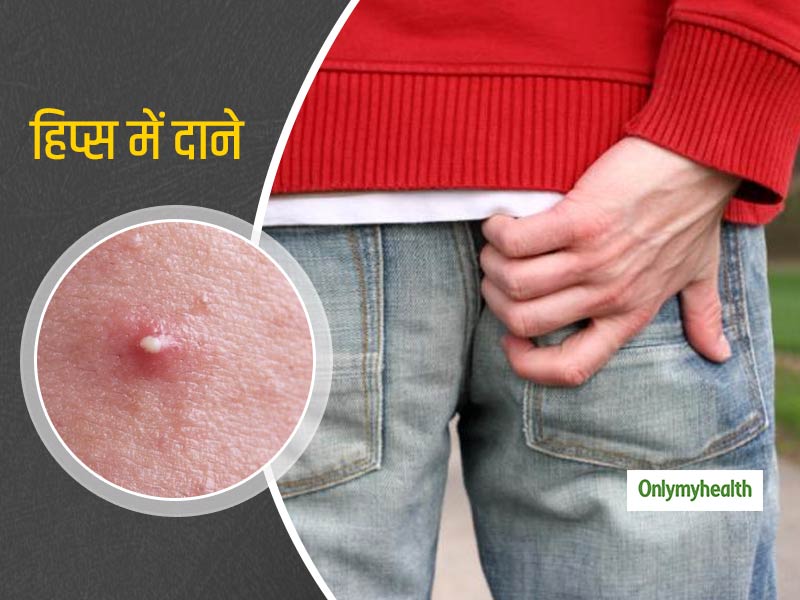 हिप्स में दाने या पिंपल्स निकलने का क्या है कारण? जानें इसे ठीक करने के आसान घरेलू उपाय