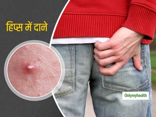 हिप्स में दाने या पिंपल्स निकलने का क्या है कारण? जानें इसे ठीक करने के आसान घरेलू उपाय