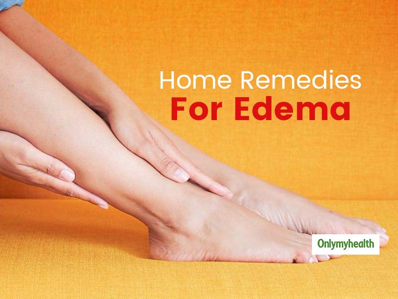 Home Remedies For Edema: Try These Remedial Options To Relieve Inflammation