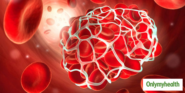 Blood Clots