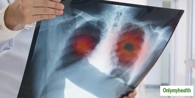 lungs cancer