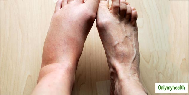 swollen feet
