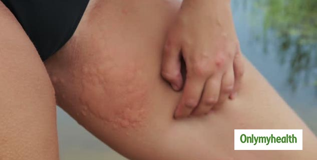 Rashes Between Legs Causes & Treatment - How To Treat Inner Thigh Rash and  chafing inner thighs 