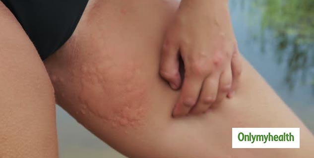 Rash on deals inner thigh female