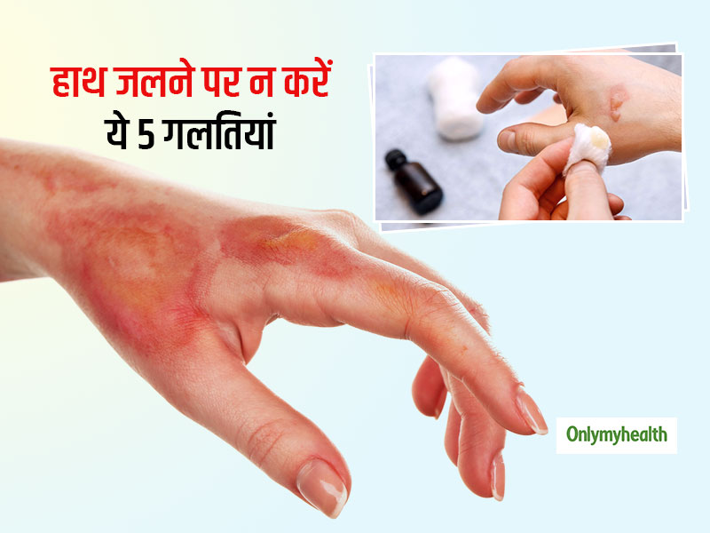 never-do-these-5-mistakes-while-treating-a-burn-in-hindi