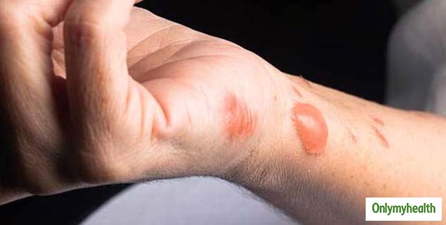 Burn While Cooking